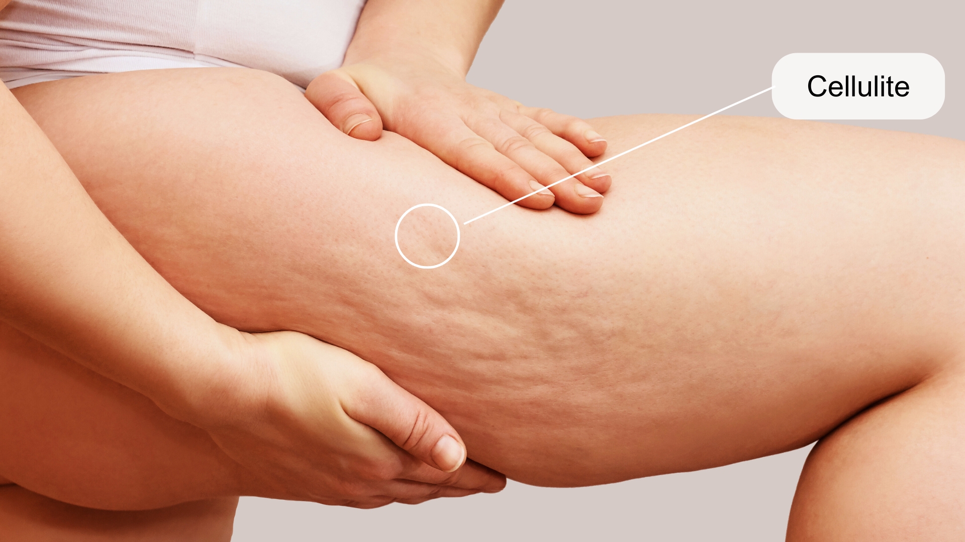 L'immagine rappresenta una donna che mostra le cellulite.