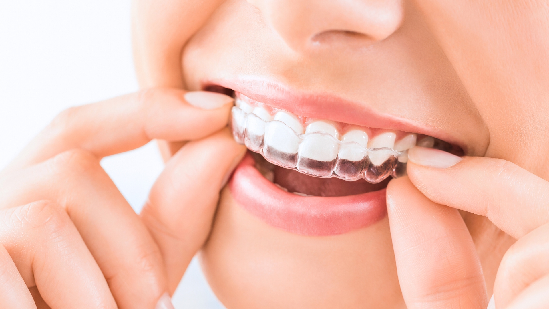 L'immagine rappresenta un bambino mentre va dal dentista.